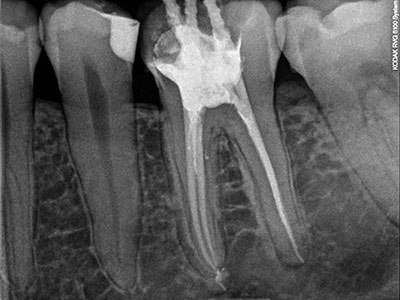 зъболекар рентгенова снимка