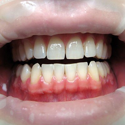 зъбите след избелването