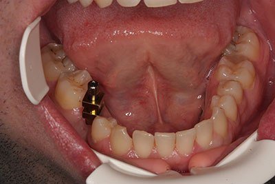 снемане на зъбен отпечатък