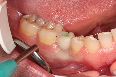 временна корона на зъба