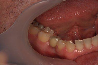 металокерамична корона на зъб