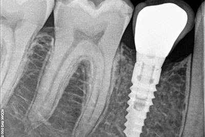 рентологична проверка на зъба