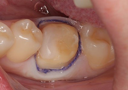 зъбна металокерамика