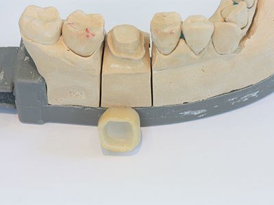 корона циментиране  зъболекар