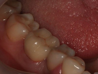 зъбна корона резултат