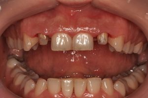 зъбите след сваляне на пломбите